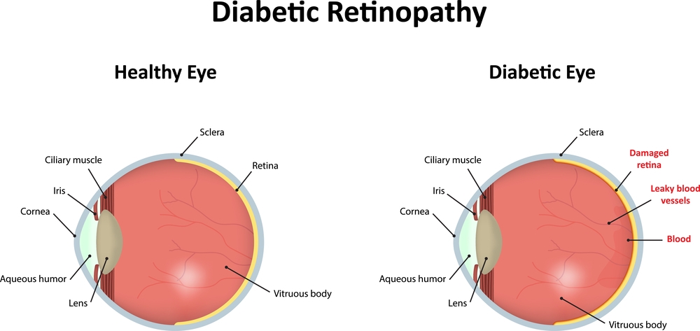 diabetic retinopathy treatment & surgery in mulund 