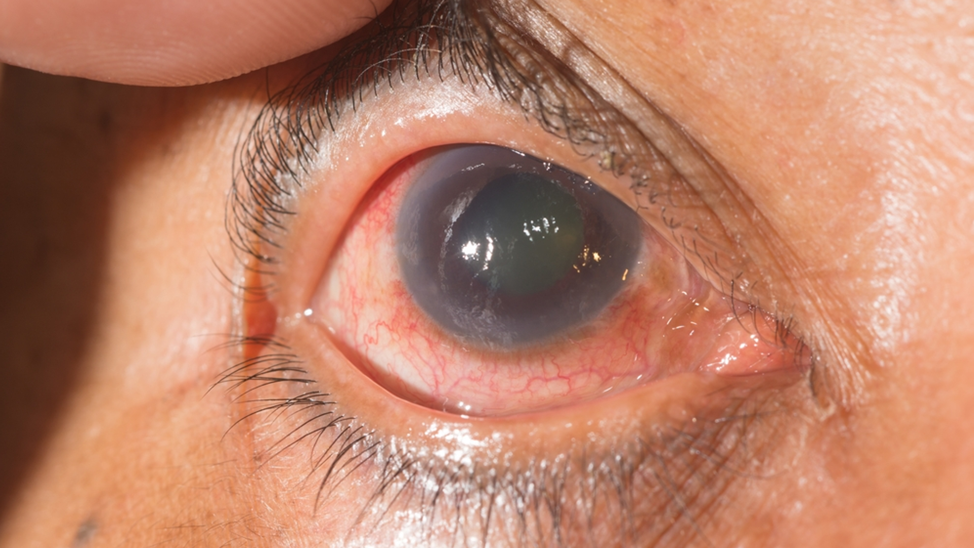 glaucoma eye disorder treatment in mulund