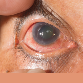 glaucoma eye disorder treatment in mulund