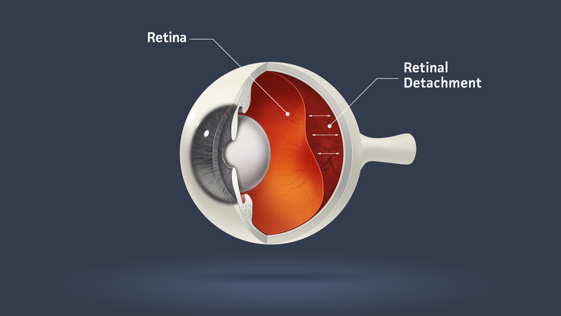 retinal detachment treatment & surgery in mulund