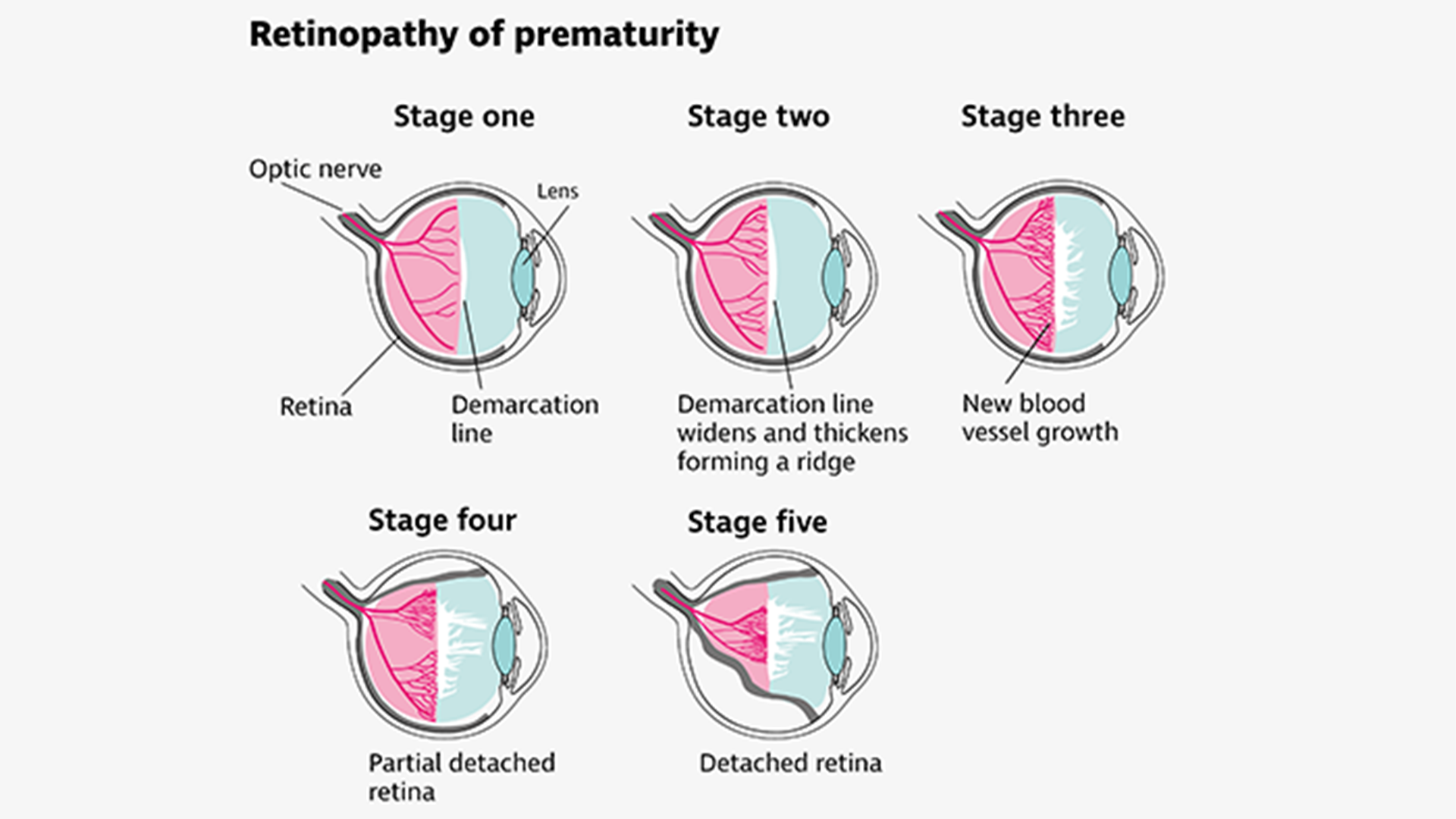 retinopathy of prematurity treatment in mulund