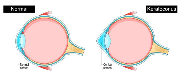 best cornea transplant doctor in mulund