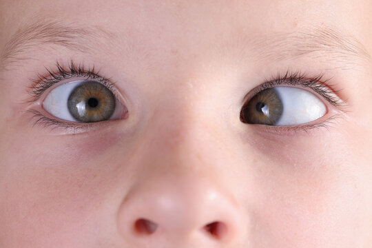 best squint treatment in mulund