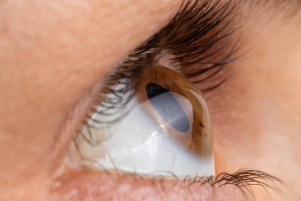 Cornea Specialist in Mulund